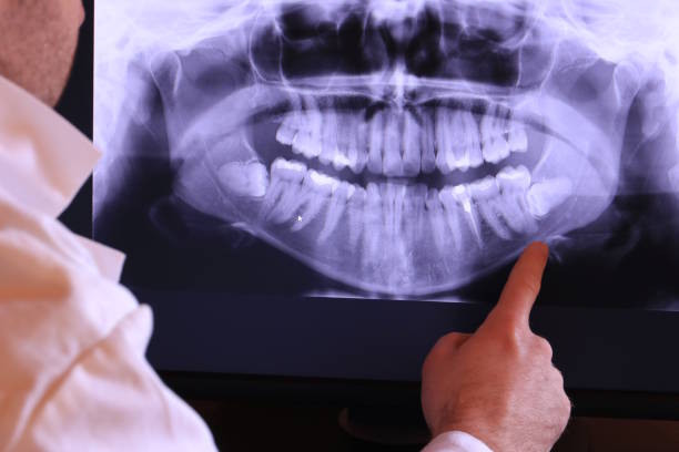 Best Emergency Wisdom Teeth Removal in Ceresco, NE